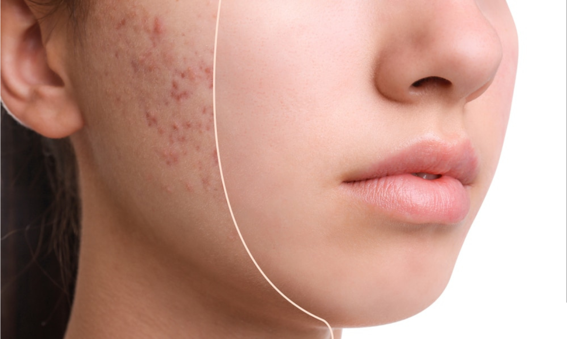 Acne
Le traitement au Laser AC Dual cible les bactéries responsables de l’acné et réduit l’inflammation de la peau.
En savoir plus