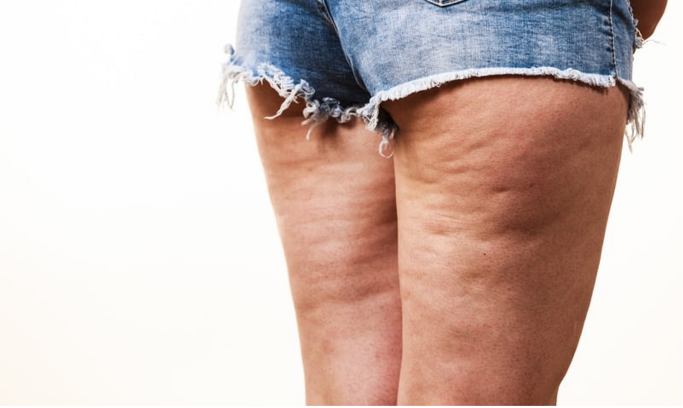 Cellulite
La cellulite provient d'une altération des tissus graisseux, créant un aspect inesthétique.
En savoir plus
