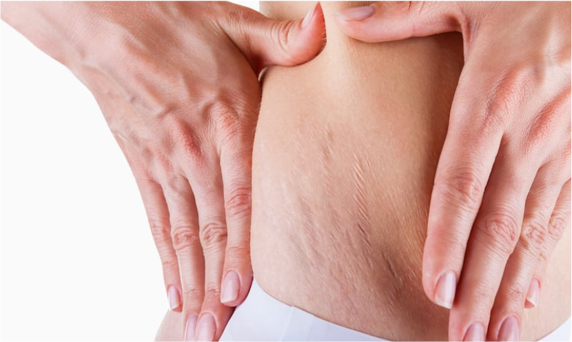 Vergeture
Le microneedling et le nano fractionnel réduisent les vergetures, raffermissent et réparent les dommages cutanés.
En savoir plus