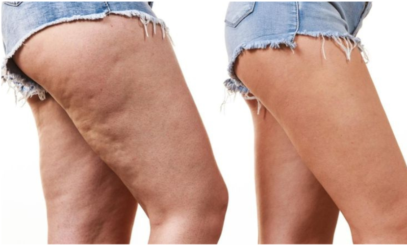 Cullote de chevale
La culotte de cheval désigne l'accumulation de graisse et de cellulite autour des hanches, des fesses et de la partie externe des cuisses.
En savoir plus
