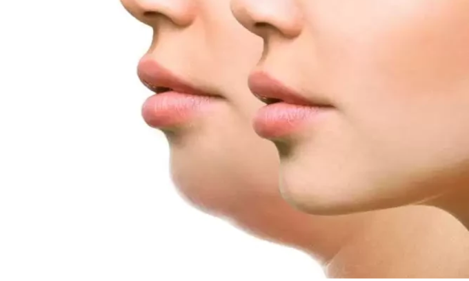 Double Chin

A double chin results from a buildup of fat under the chin, caused by aging, genetics, or weight.

Learn More