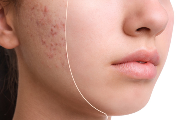 Acné
Le traitement au Laser AC Dual cible les bactéries responsables de l’acné et réduit l’inflammation de la peau.
En savoir plus