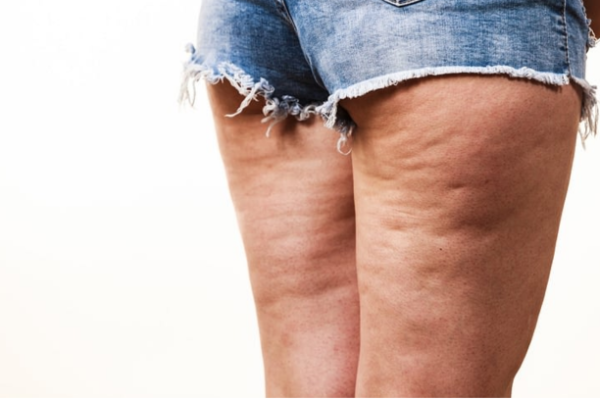 Cellulite
La cellulite provient d'une altération des tissus graisseux, créant un aspect inesthétique.
En savoir plus