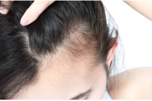 Perte de cheveux
Mésothérapie et microneedling stimulent la repousse, freinent la chute et densifient les cheveux naturellement.
En savoir plus