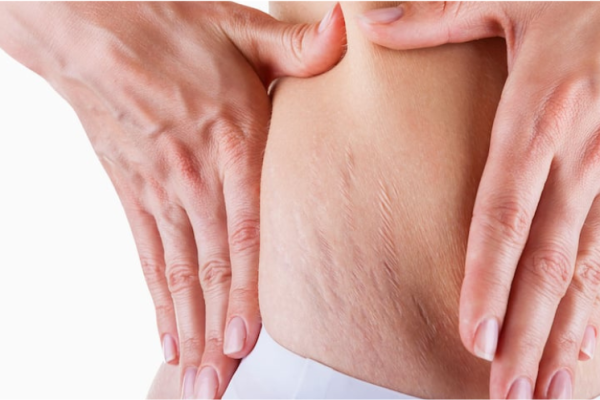 Vergeture
Le microneedling et le nano fractionnel réduisent les vergetures, raffermissent et réparent les dommages cutanés.
En savoir plus
