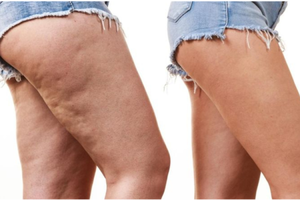 Cullote de chevale
La culotte de cheval désigne l'accumulation de graisse et de cellulite autour des hanches, des fesses et de la partie externe des cuisses.
En savoir plus
